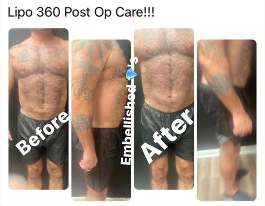 Post-Op Care/ Tummy Tucks-BBL's-Lipo 360